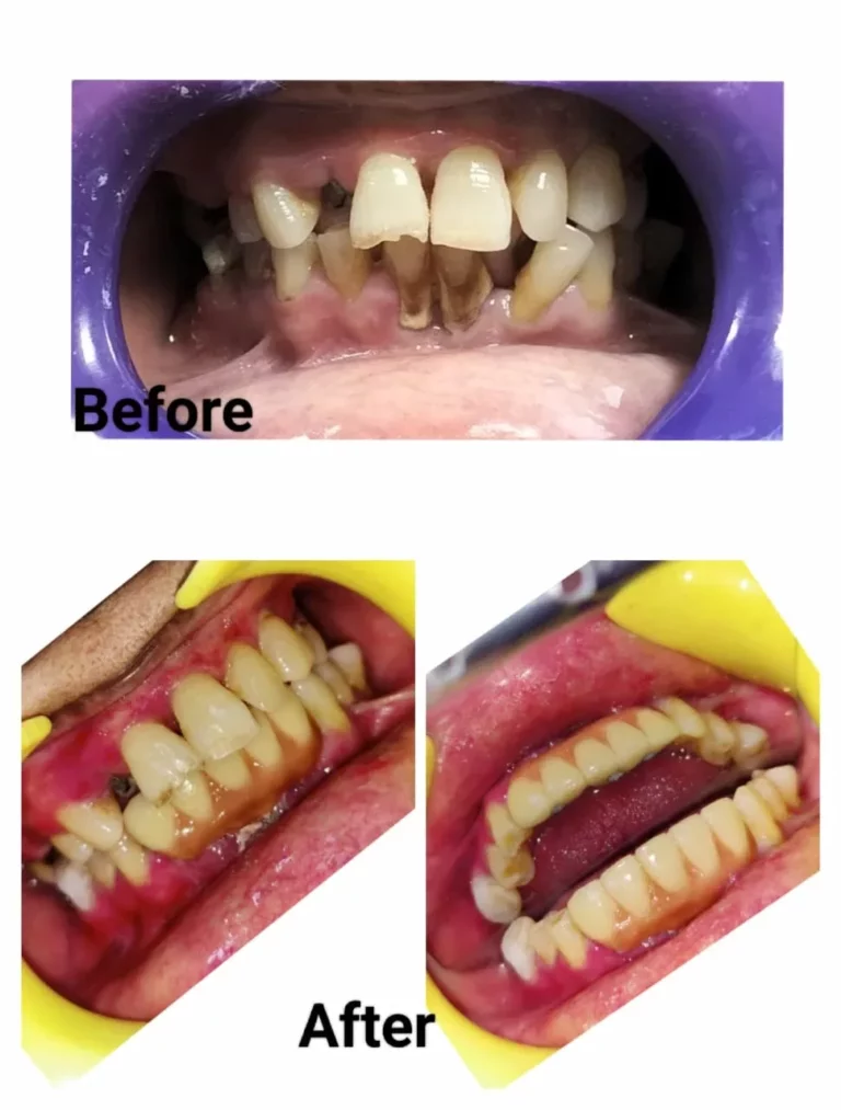 Basal Implant