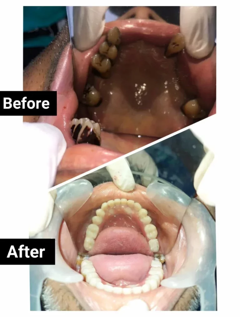 Zygomatic Implant 1