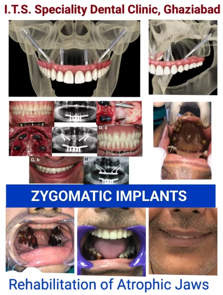 Zygomatic Implants