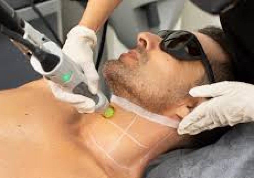 beard shaping (laser hair reduction)(1)